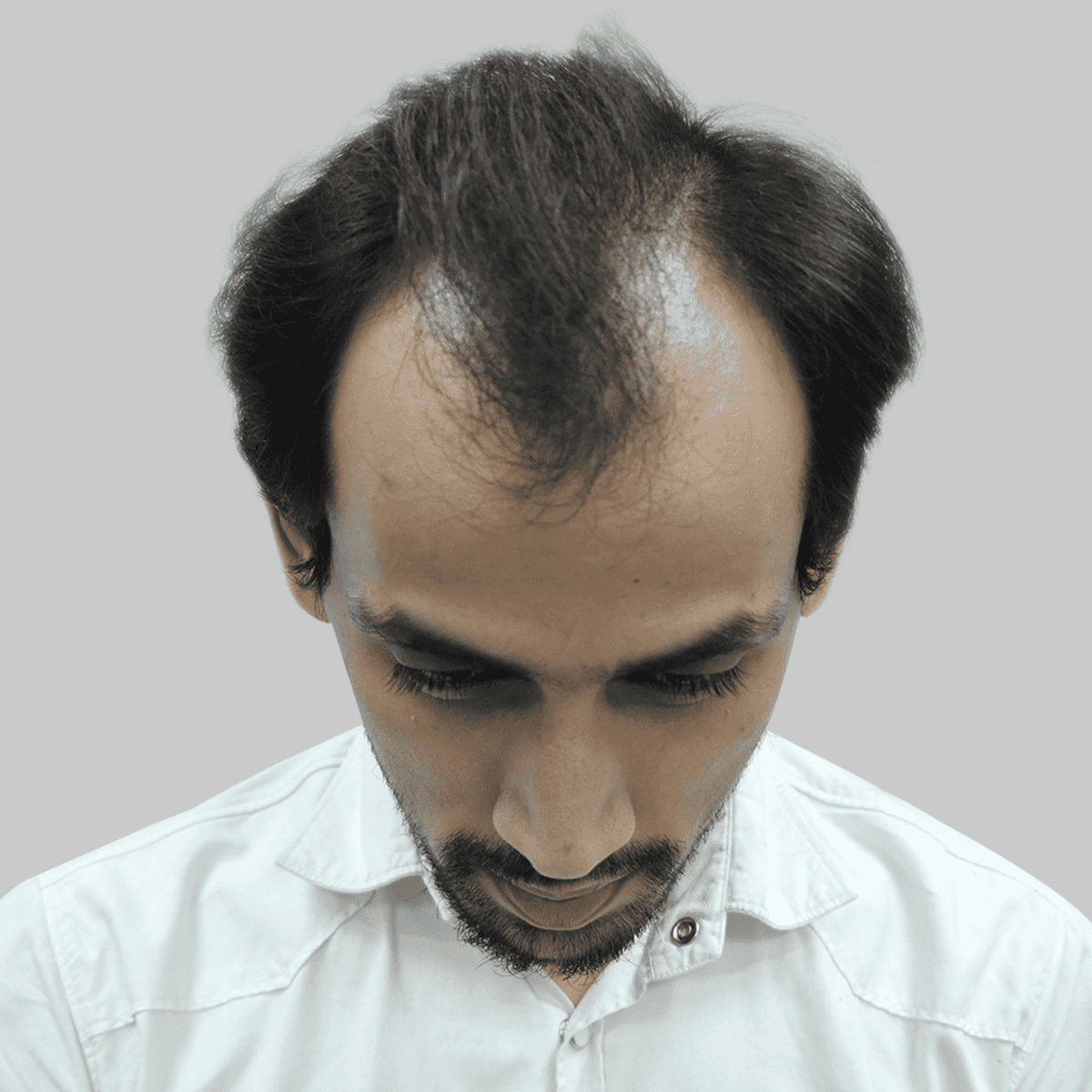 hair transplant image