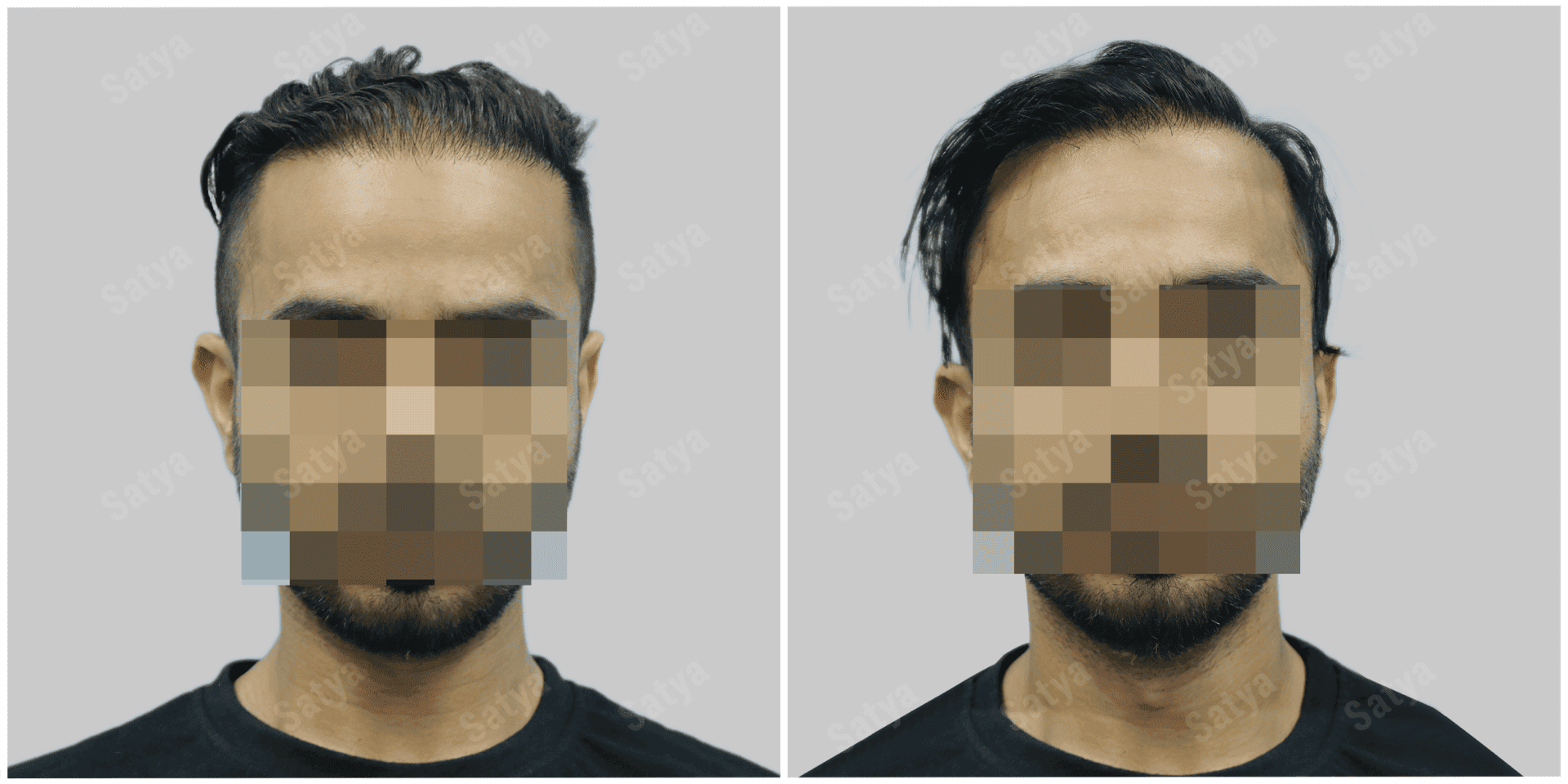 hair transplant results before and after