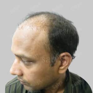 Hair Transplant Surgery Before and After Results