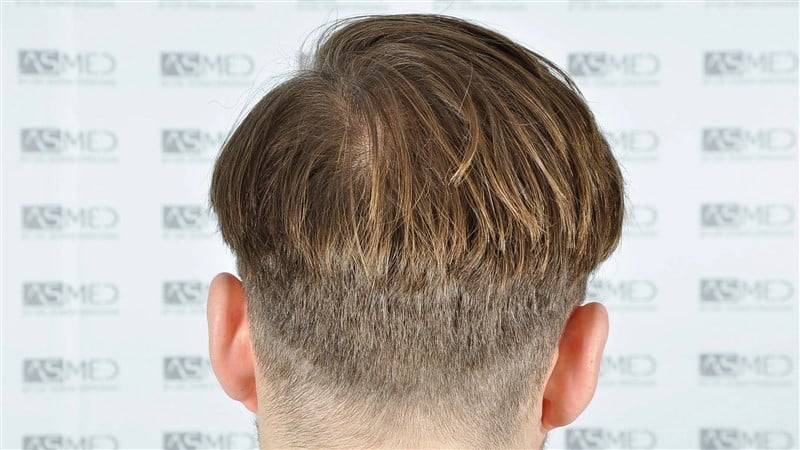 How a second repeat FUE can damage your hair?