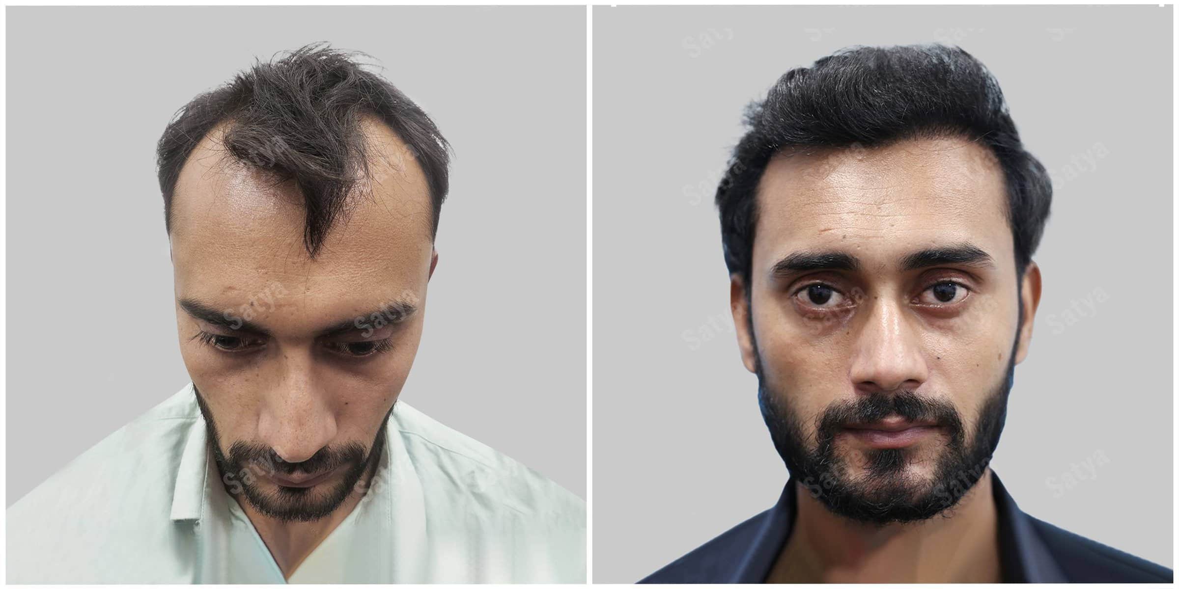hair transplant results before and after