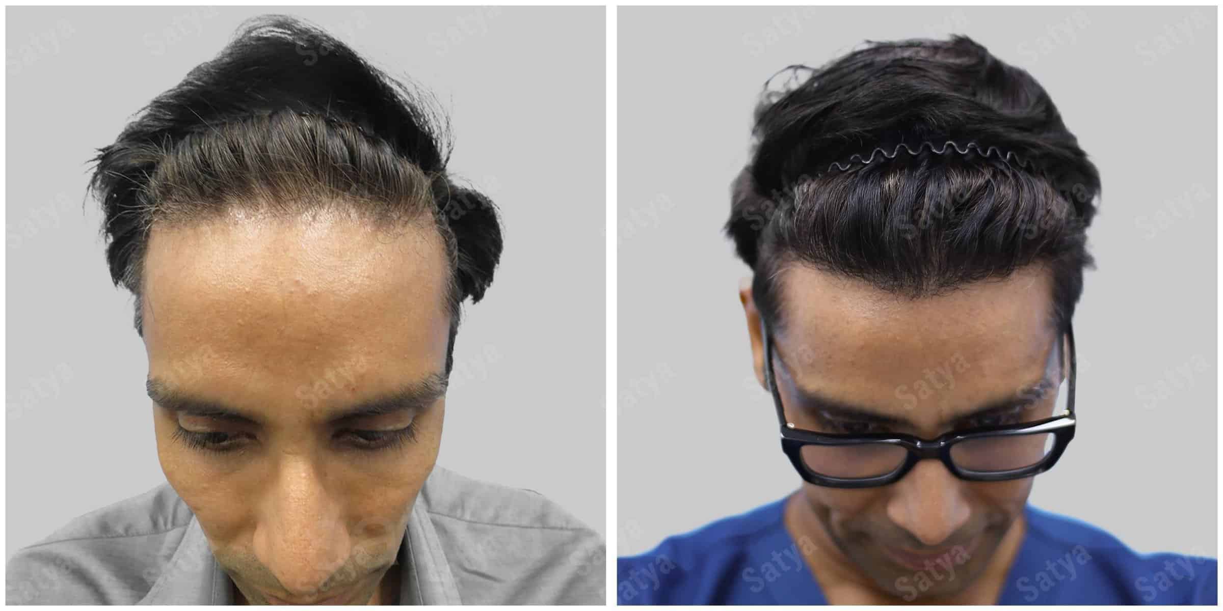 Hair Transplant Surgery Before and After Results