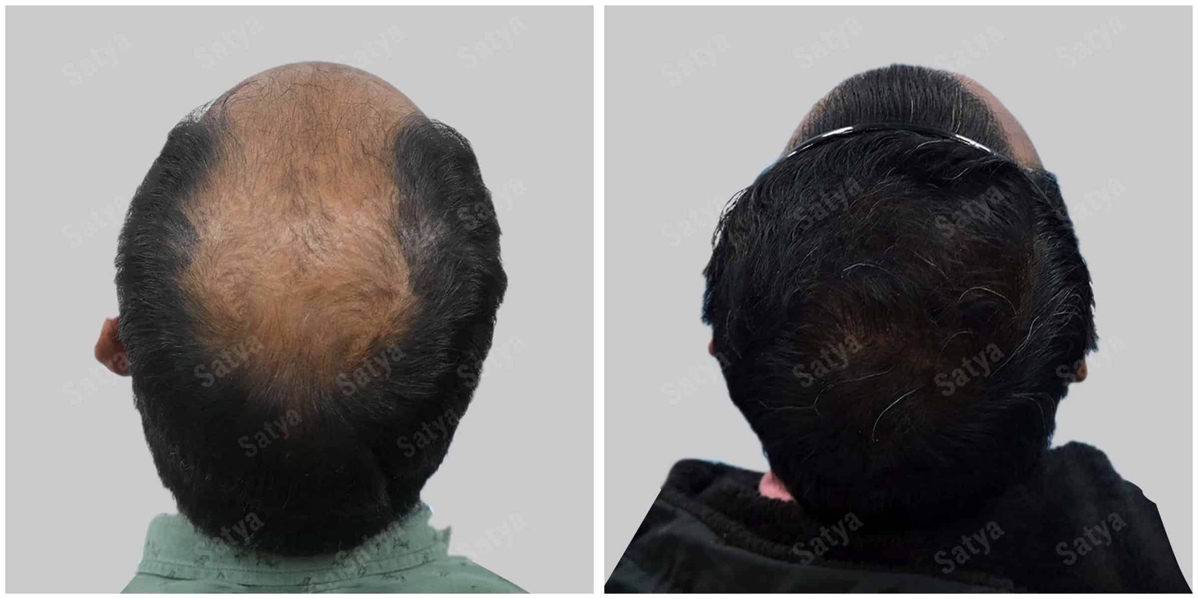 men hair transplant - Satya hair solutions