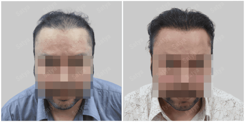 Men Hair Transplants: Satya hair Solutions