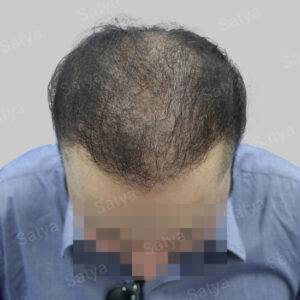 Men Hair Transplants: Satya hair Solutions