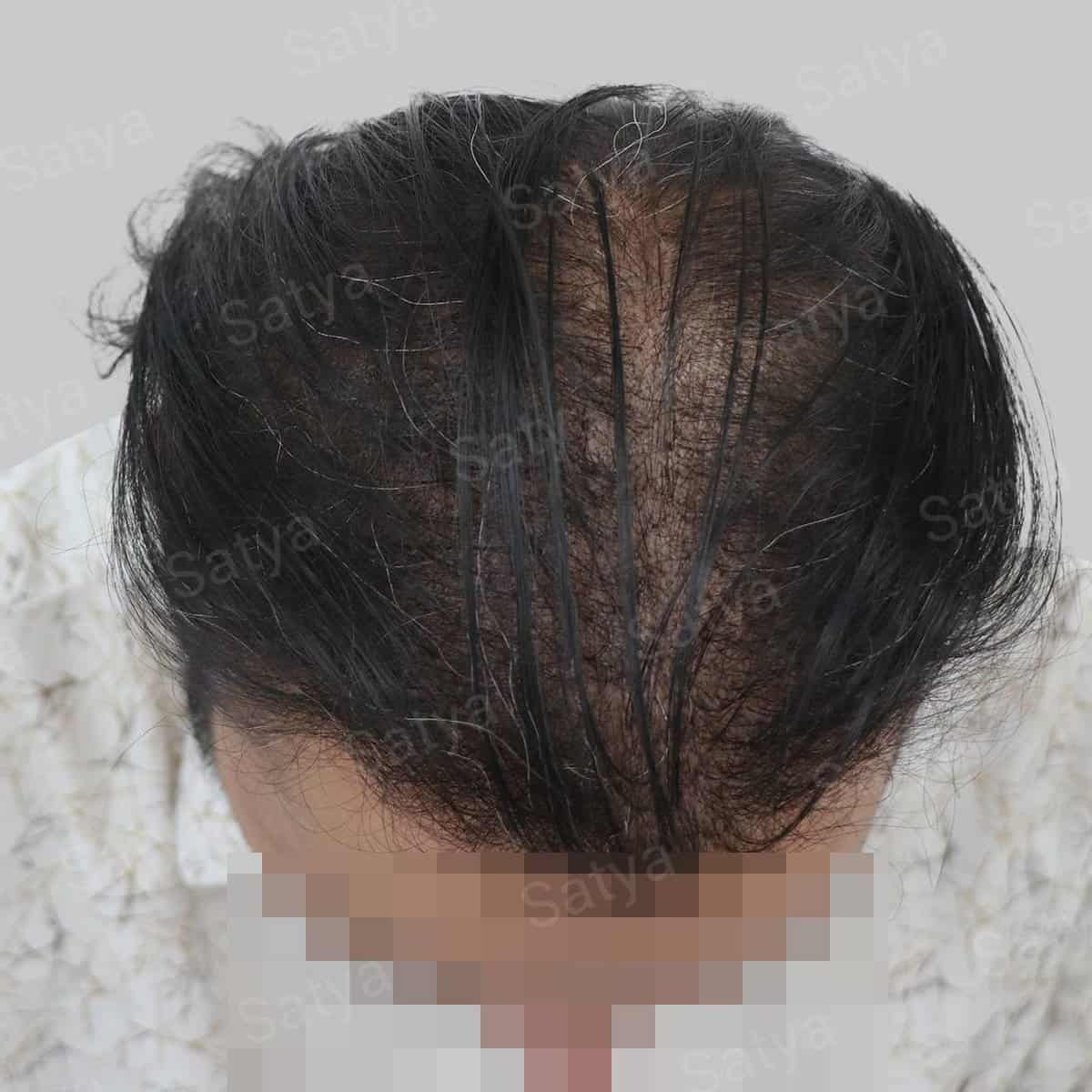 Best Hair Transplant Clinic in Delhi – India | Satya hair solutions