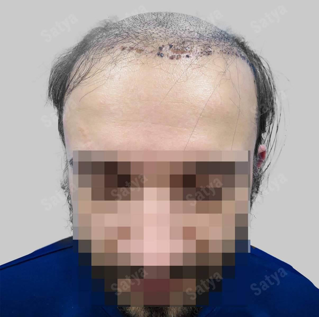 Hair Transplant for Men | before and after