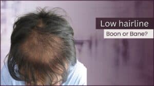 Low Hairline after transplant – Boon or Bane?