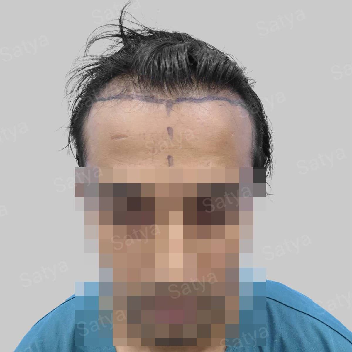 Hair Transplant Surgery Before and After Results Satya hair solutions