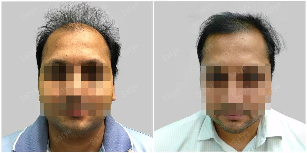 Hair Transplant Before and After Results | Satya hair Solutions
