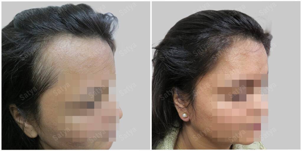 female hair transplant in india before and after