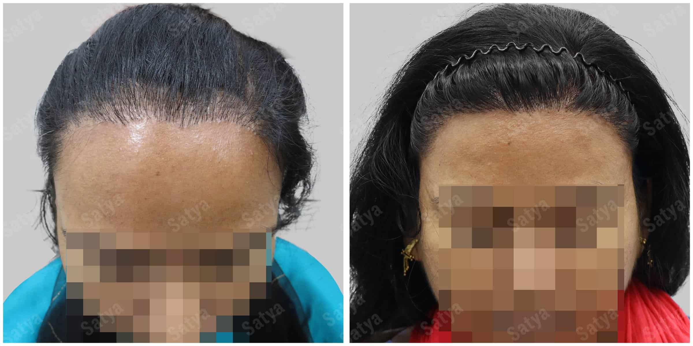 synthetic hair transplant Female hair transplant