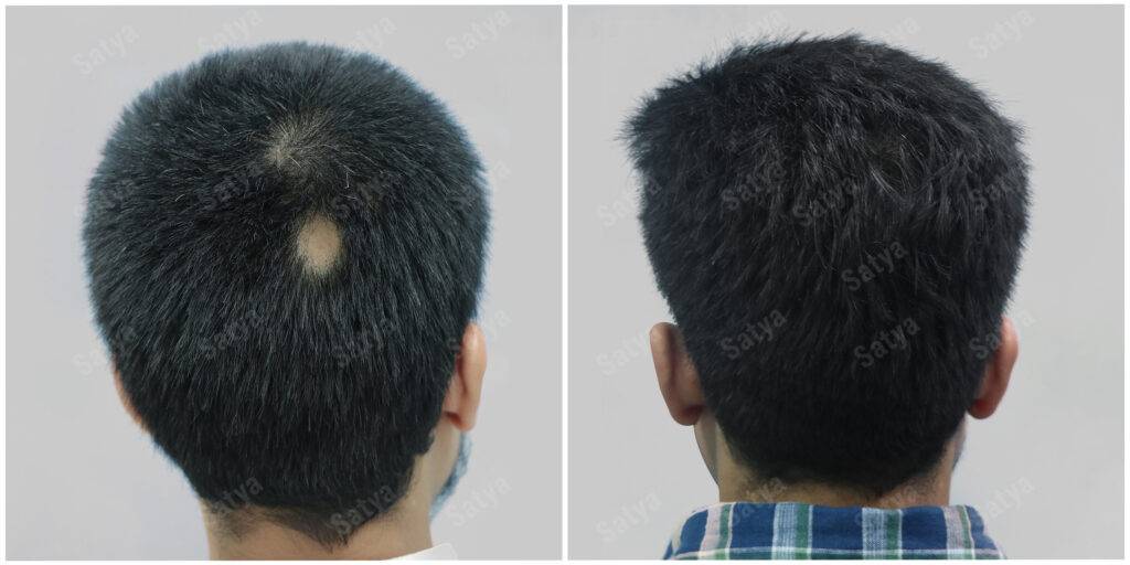 Gzyan goyal- Alopecia areta results