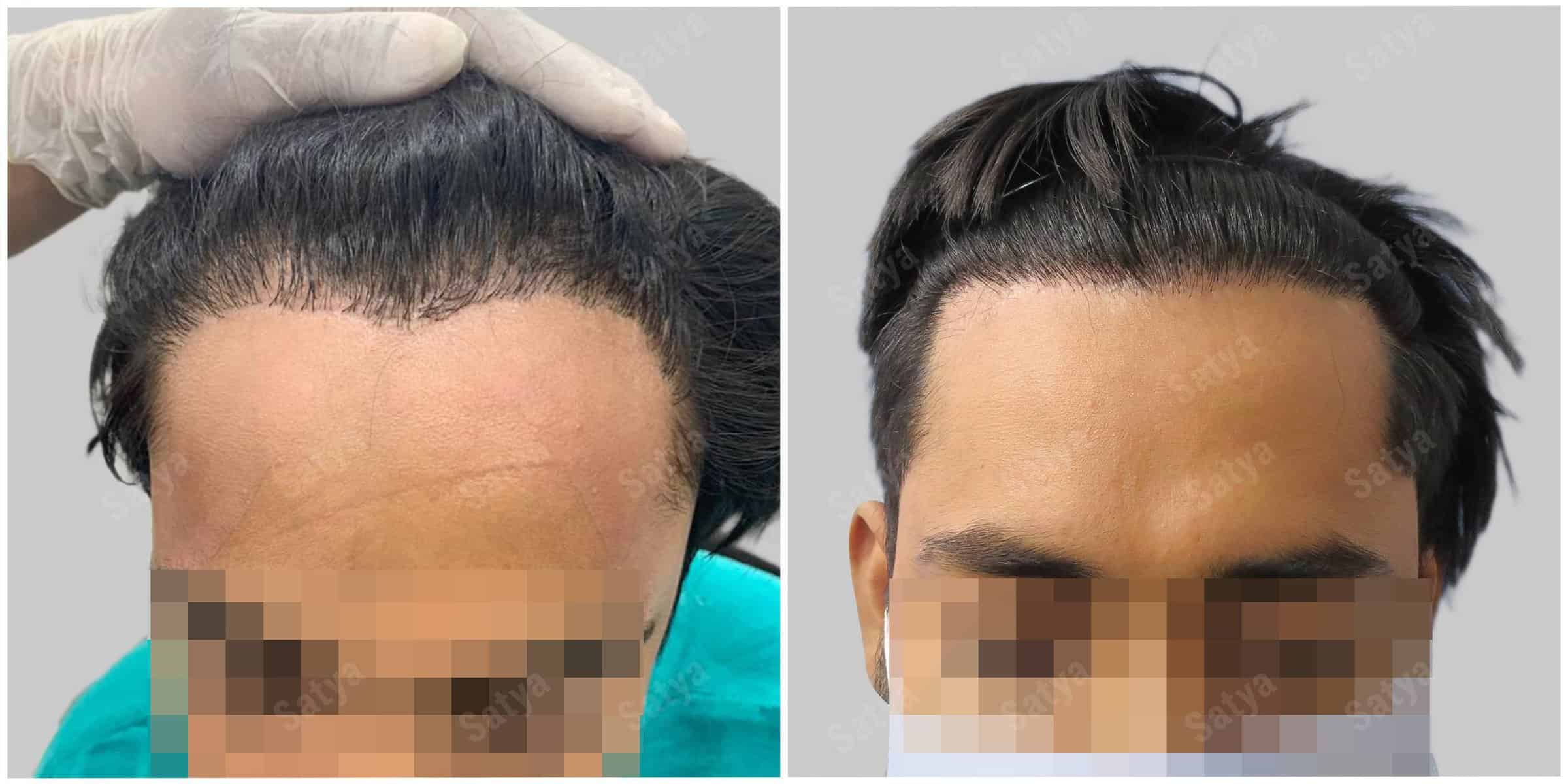 hair transplant results