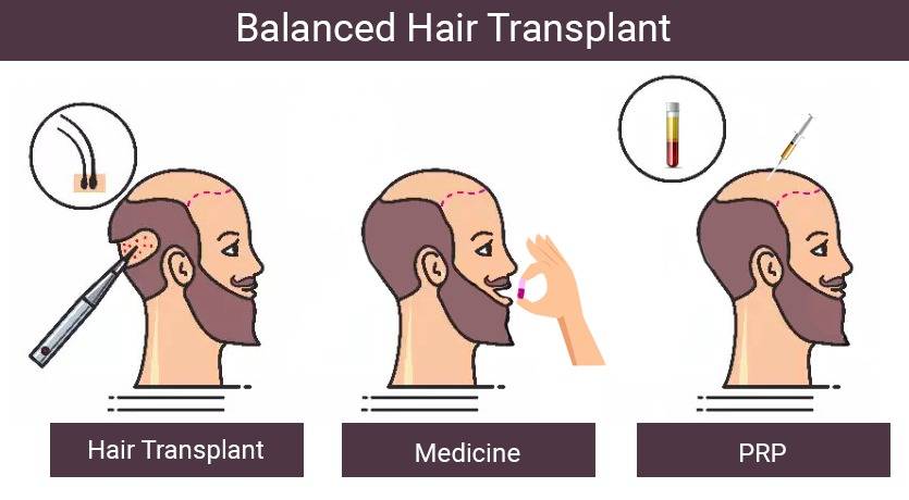 balanced hair transplant