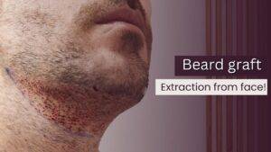 Avoid Beard Graft Extraction from Face for Repair Hair Transplant