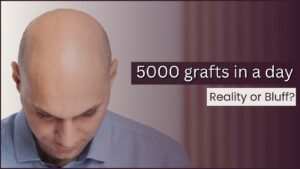 Is it possible  5000 grafts in a day? Reality or Bluff?