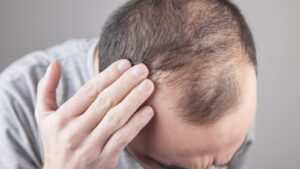Do men and women have different patterns of hair loss?