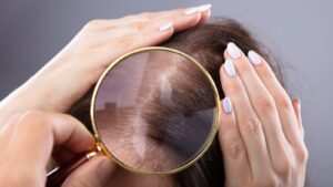 Which Method is Best for Female Hair Transplant?