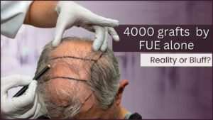 4000 + grafts by FUE alone Is it  Reality or Bluff??