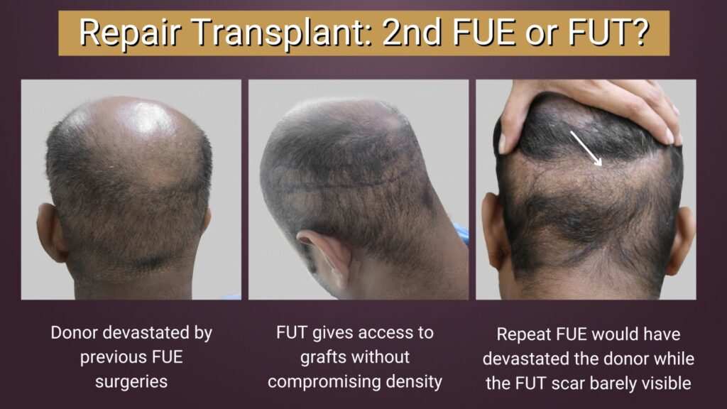 fue hair transplant