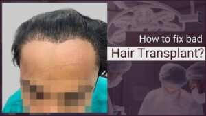 Repair hair transplants