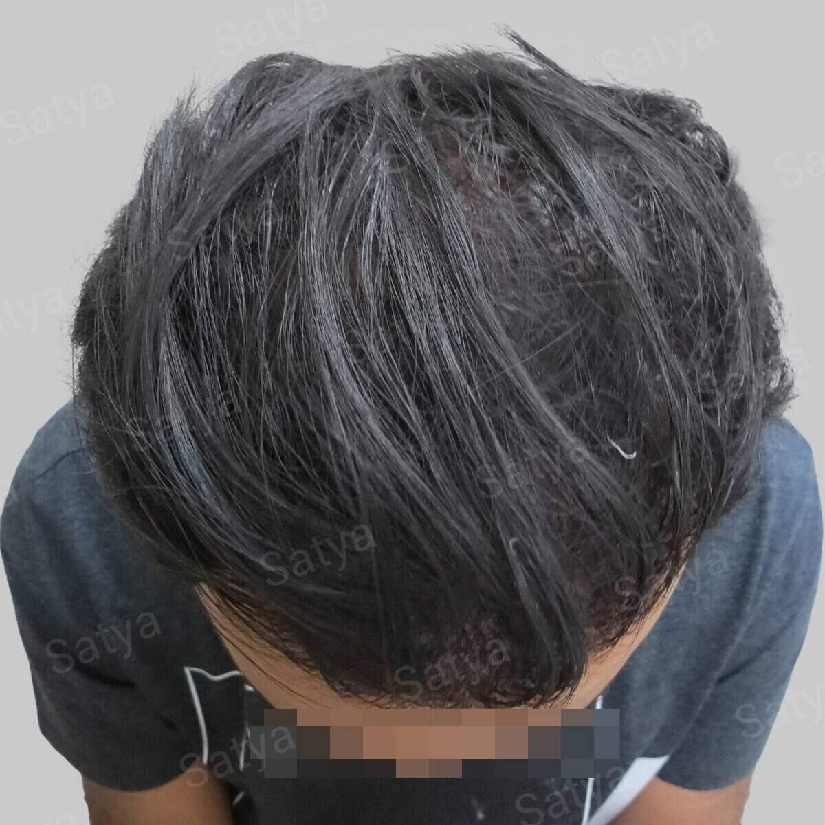 men hair line - Satya hair solutions