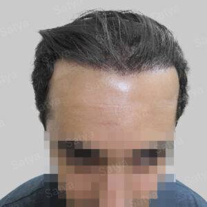 men hair line - Satya hair solutions