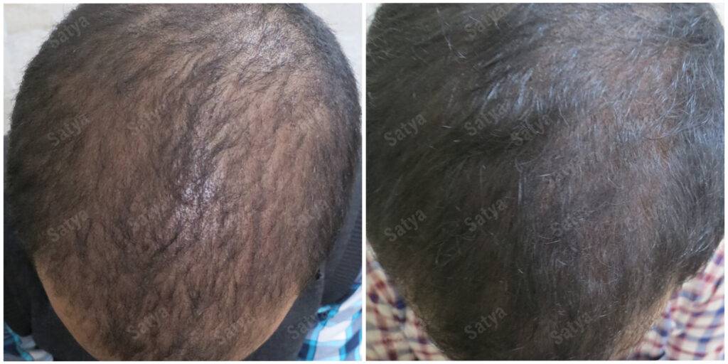arvind hair transplant results before and after
