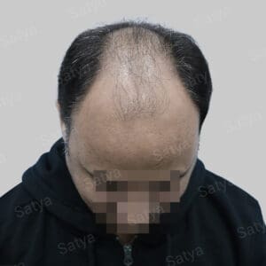 synthetic hair implant