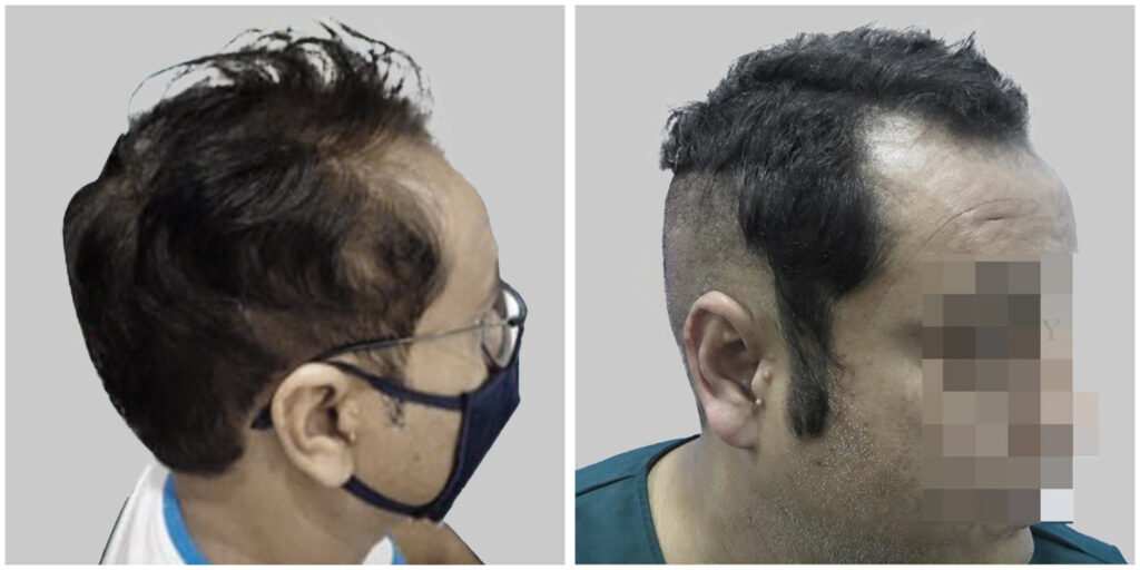 synthetic hair implant in delhi