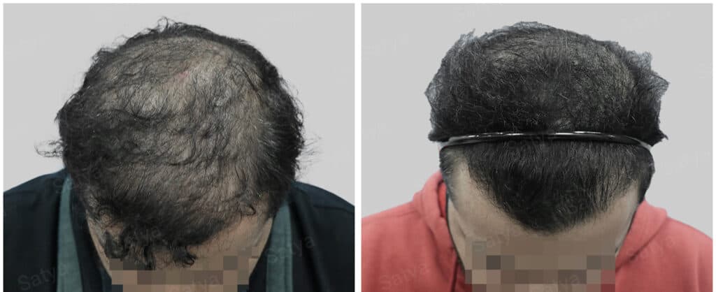 synthetic hair implant in india