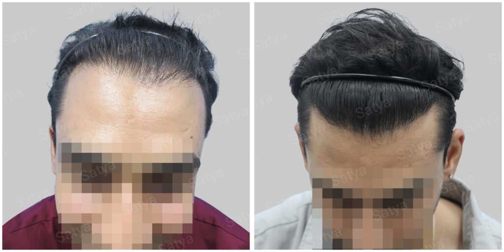 repair hair transplant