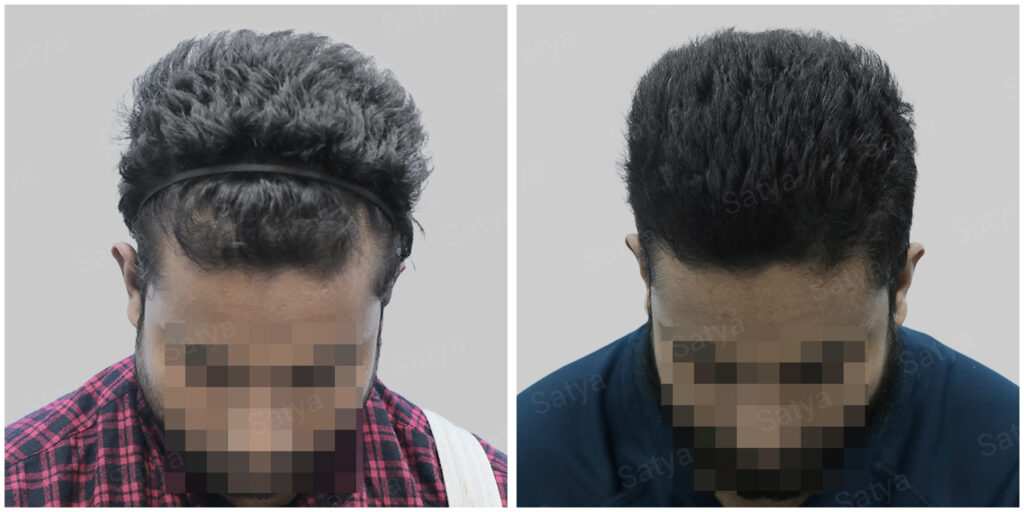 synthetic hair implant in india