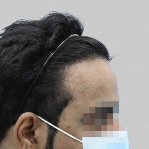 repair hair transplant result