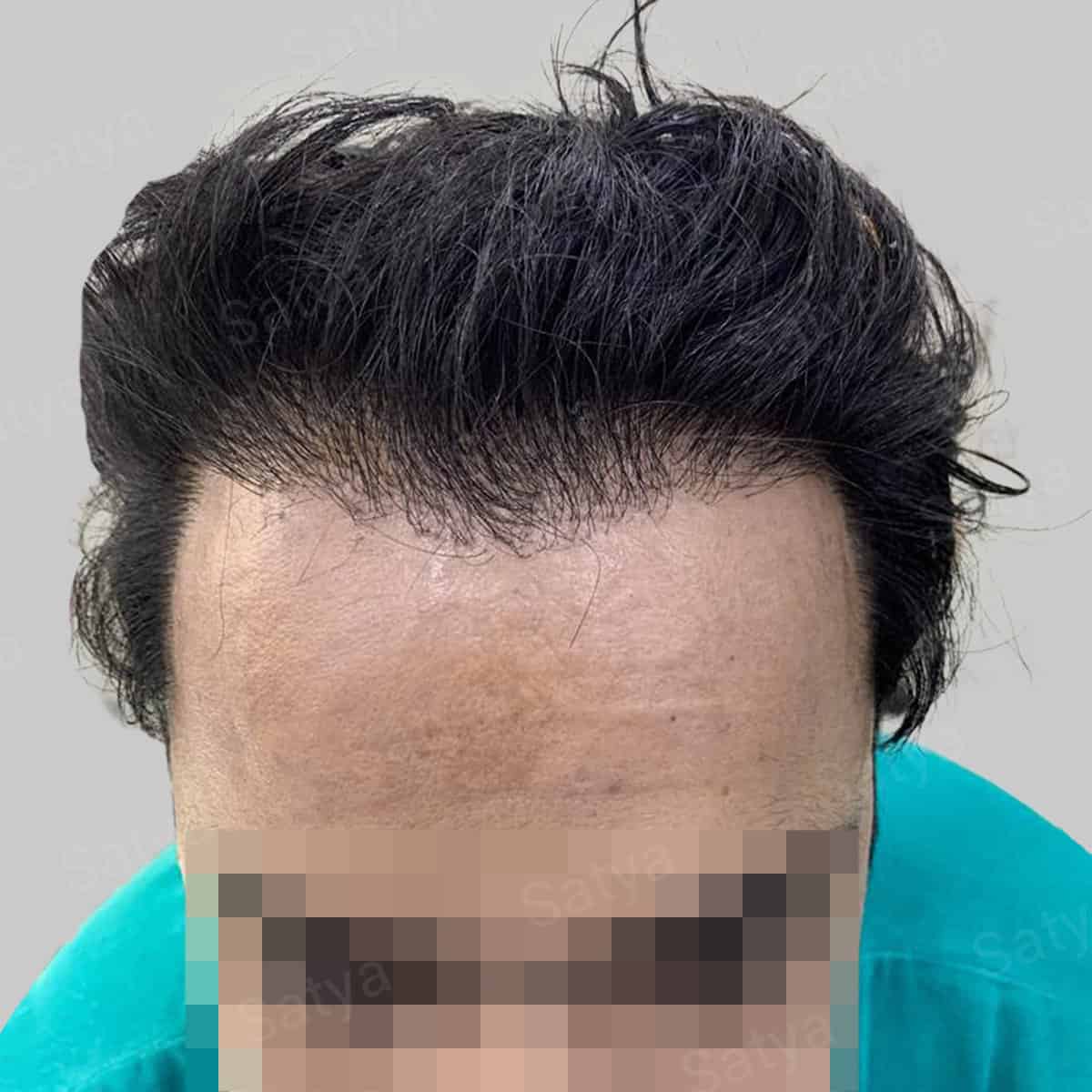corrective hair transplant result