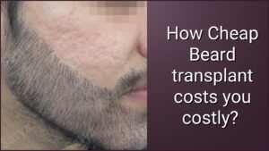 Why You Should Never Choose a Cheap Beard Transplant
