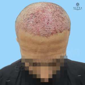 synthetic hair implant