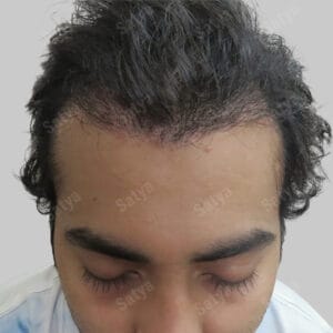 synthetic hair transplant