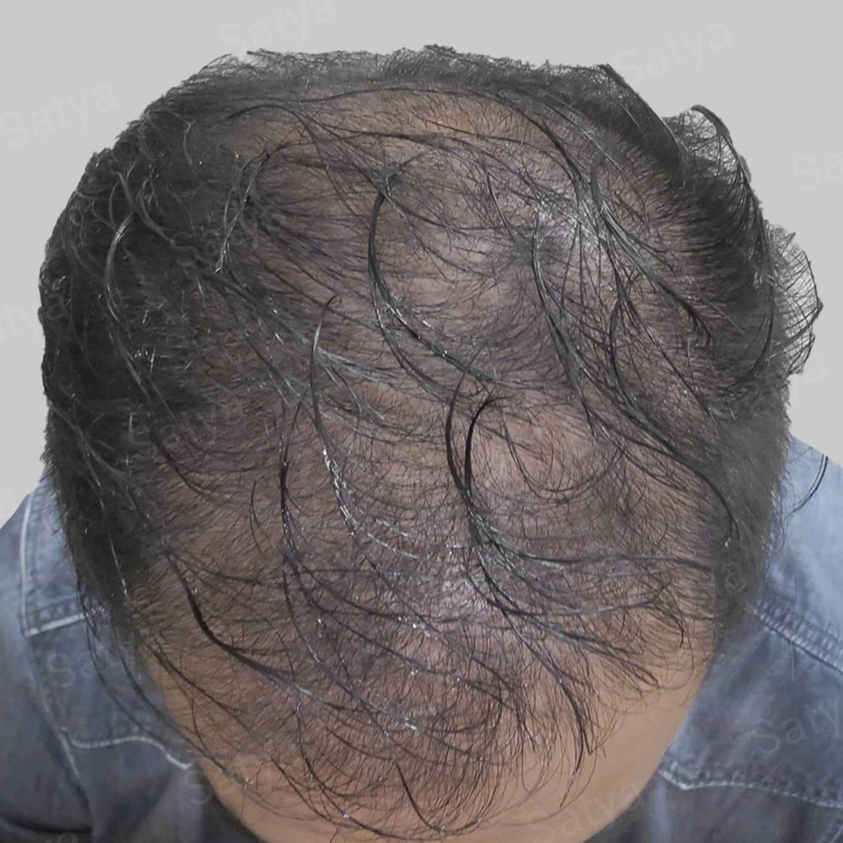 artificial hair implant