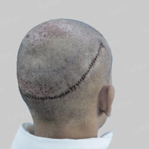 artificial hair transplant