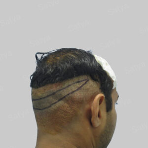 hair transplant in india