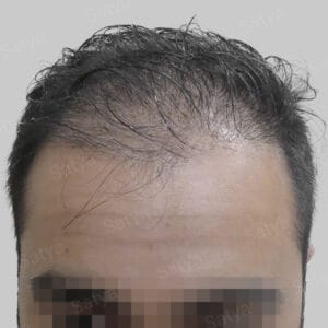 artificial hair transplant