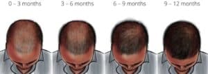 How Long Does Finasteride Start  to Work?