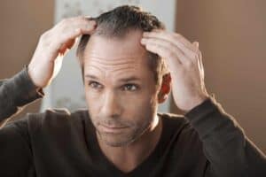 Treatments, Causes, and Symptoms of Male Pattern Baldness