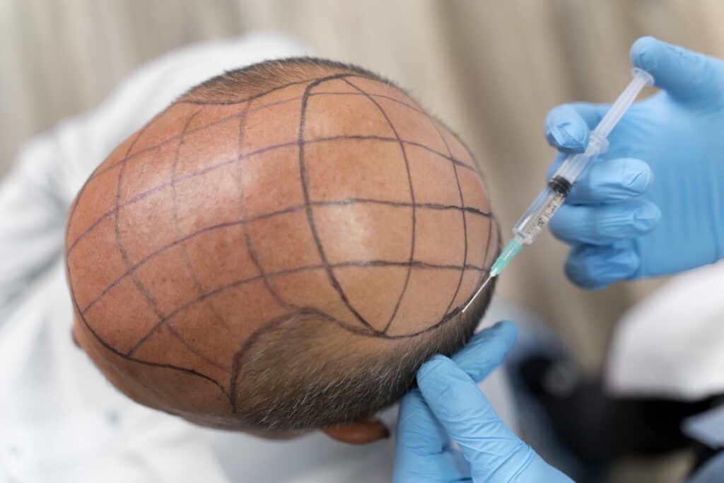 artificial hair transplant performed