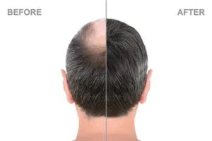 The Top 5 Advantages of Hair Restoration Treatment