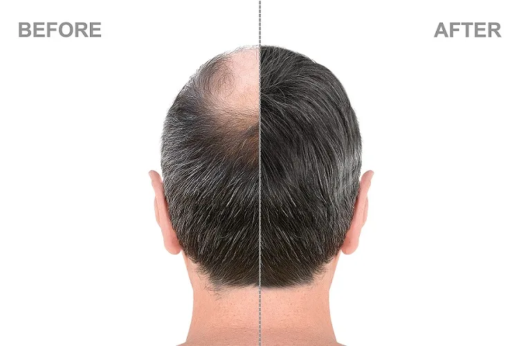 Advantages of Hair Restoration Treatment