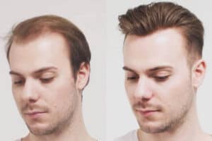 Hair Restoration Systems Benefits: A Good Way To End Hair Loss
