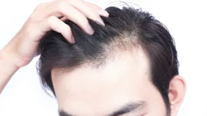 Is Hair Transplant A Successful Treatment For The Problem Of Hair Thinning?